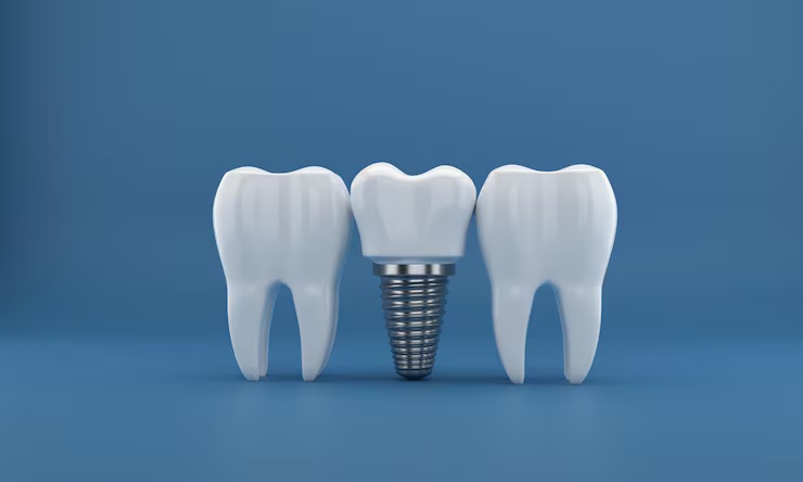 Dental implants Encino